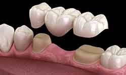 A 3D illustration of a traditional dental bridge