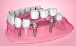 A 3D illustration of an implant bridge