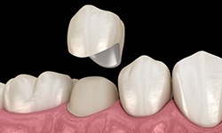 A 3D illustration of a dental crown being placed