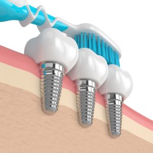 Image of a toothbrush cleaning dental implants in Greenfield.
